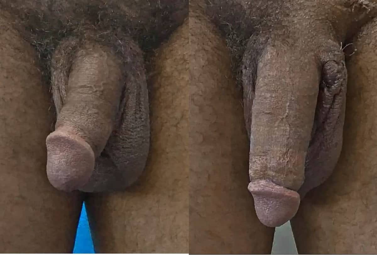 Case 14085 - penis enlargement