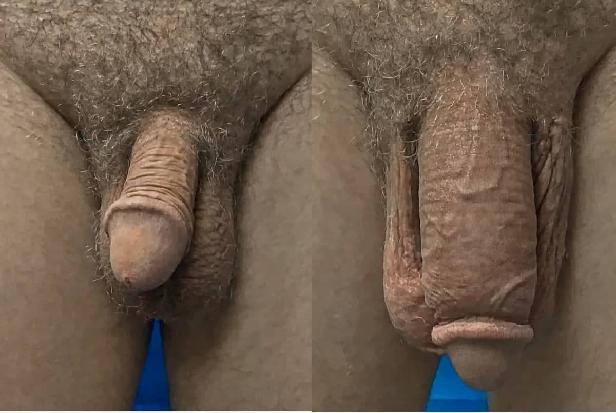 Case 14088 - penis enlargement