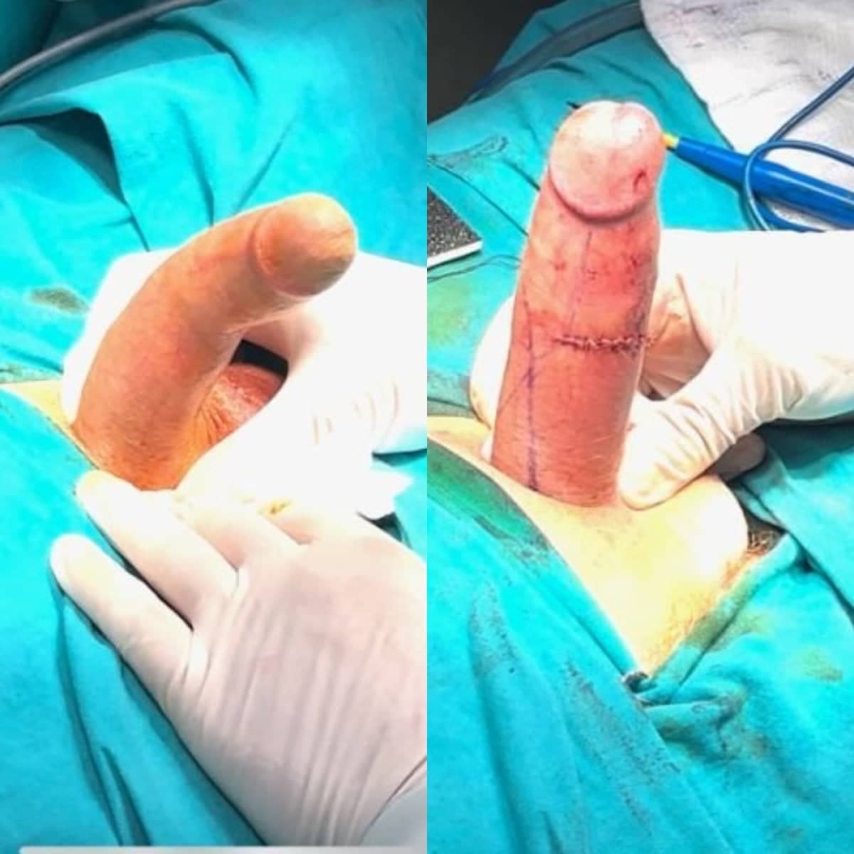 Case 14089 - penile curvature correction