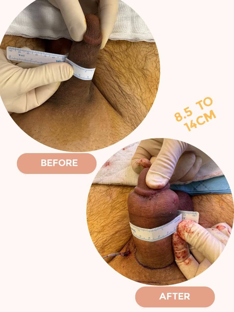 Case 14092 - penis enlargement
