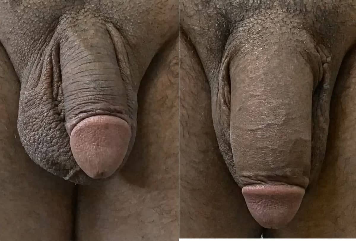 Case 14094 - penis enlargement