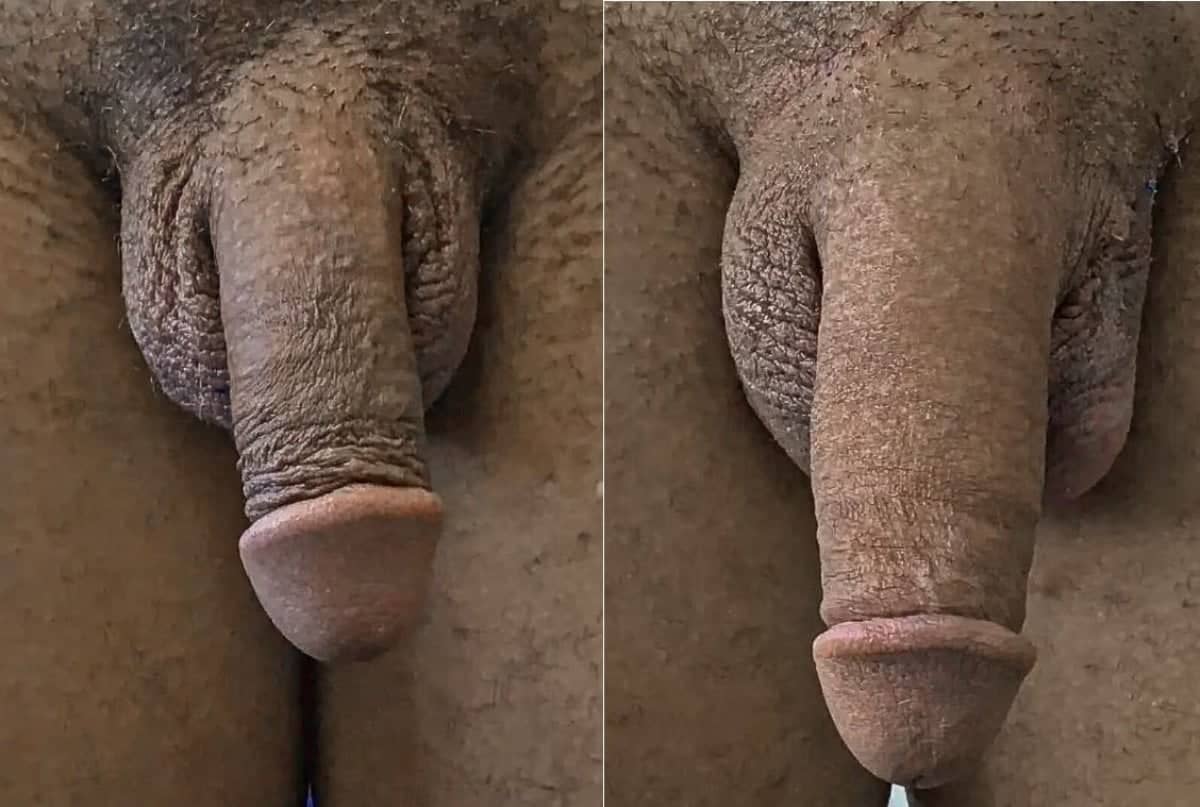 Case 14097 - penis enlargement