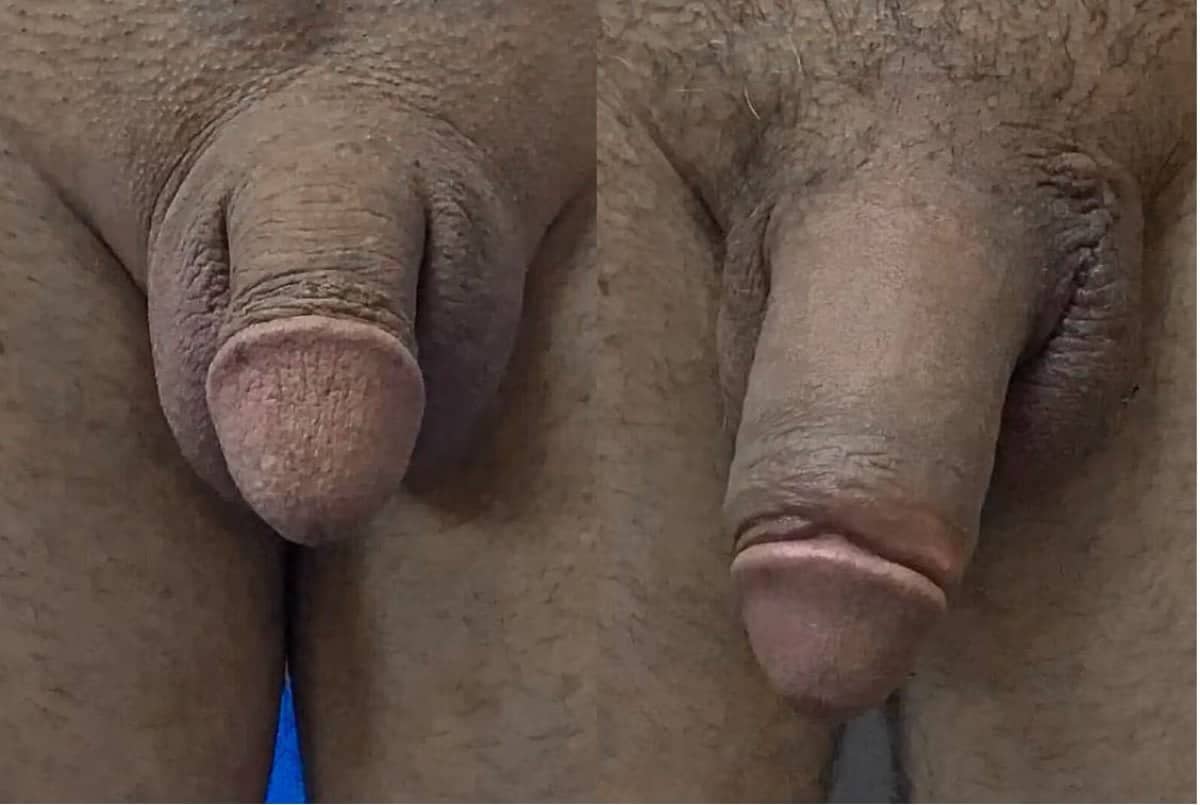 Case 14098 - penis enlargement