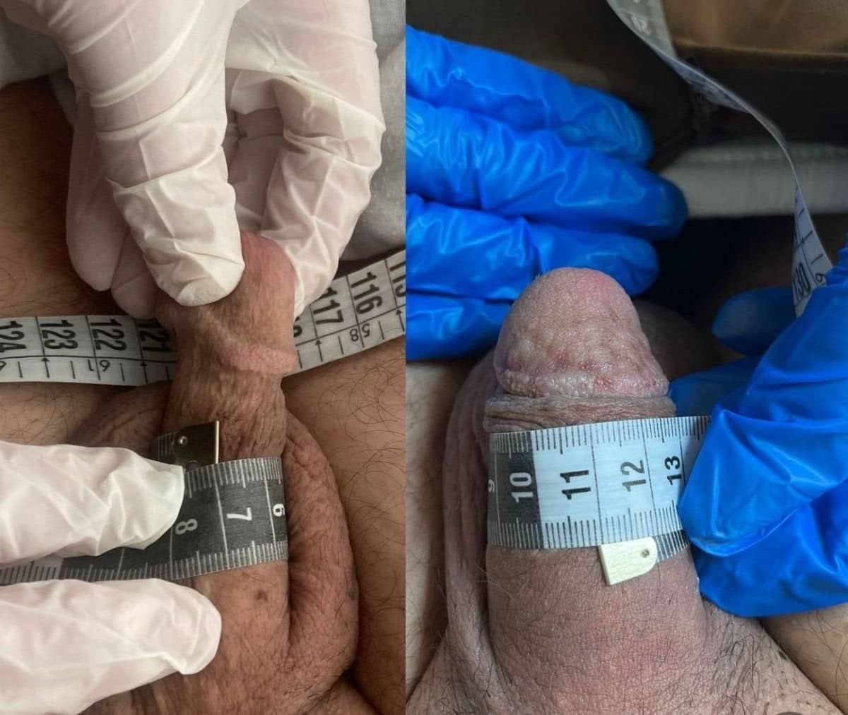 Case 14099 - penile implant surgery