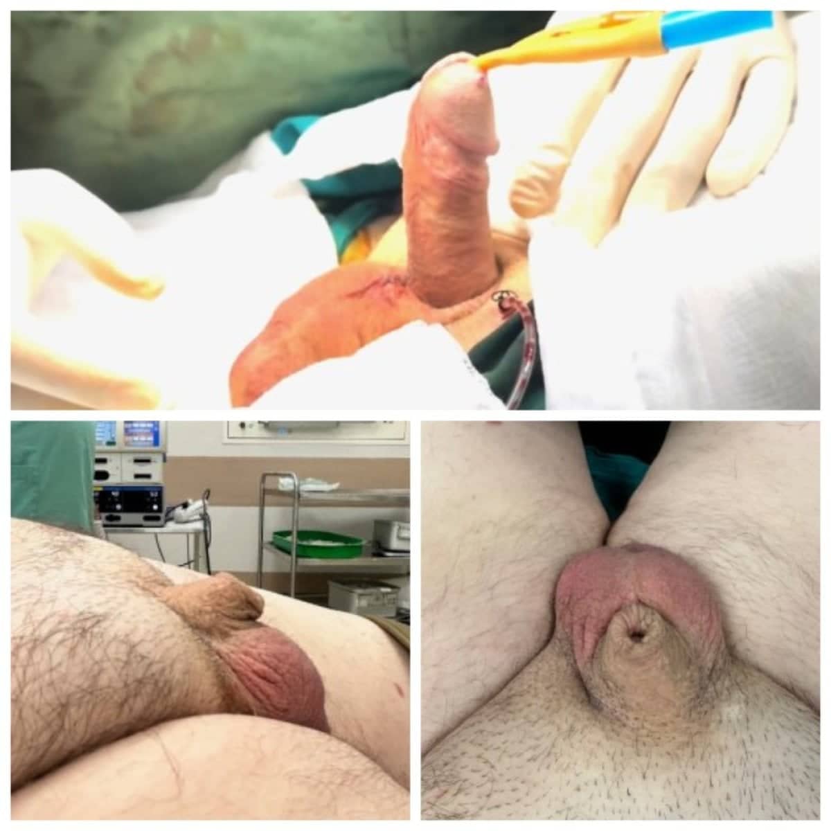 Case 14100 - penile implant surgery
