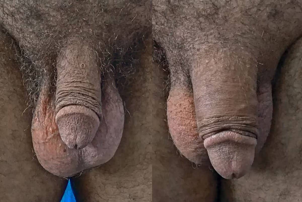 Case 14106 - penis enlargement