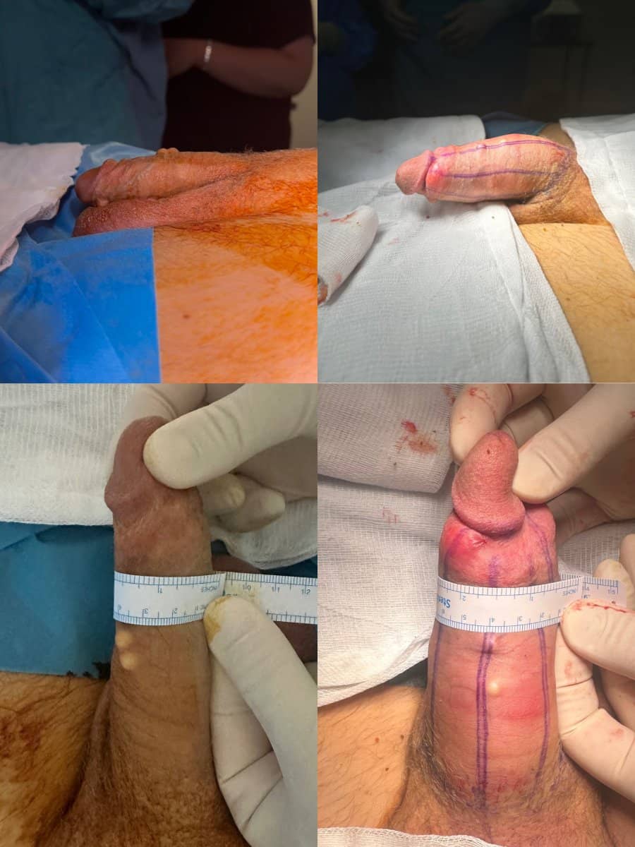 Case 14108 - penis enlargement