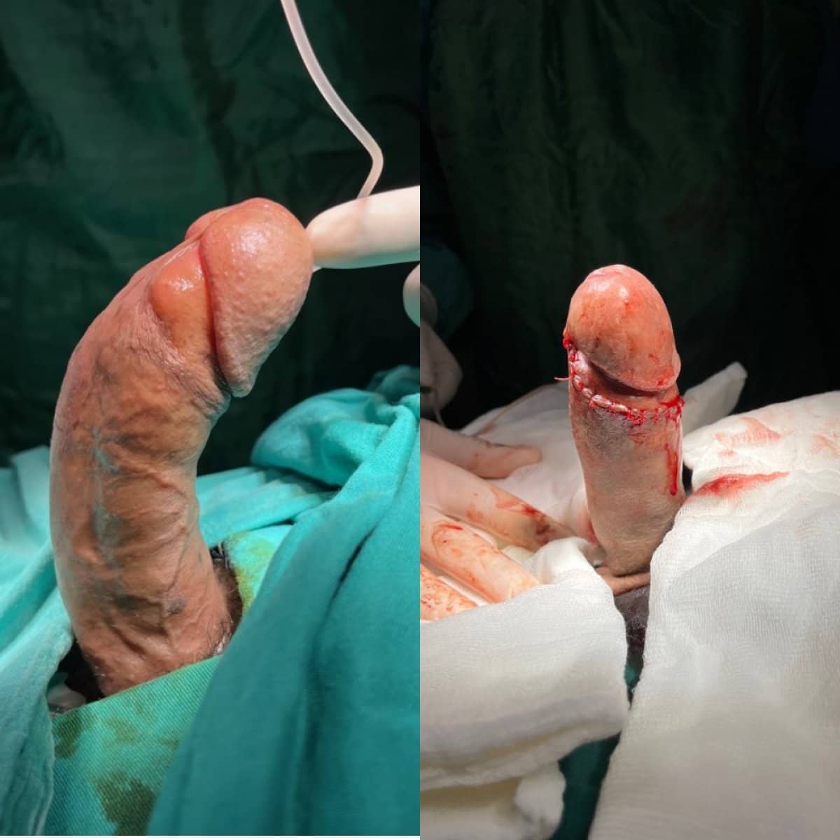 Case 14113 - penile curvature correction