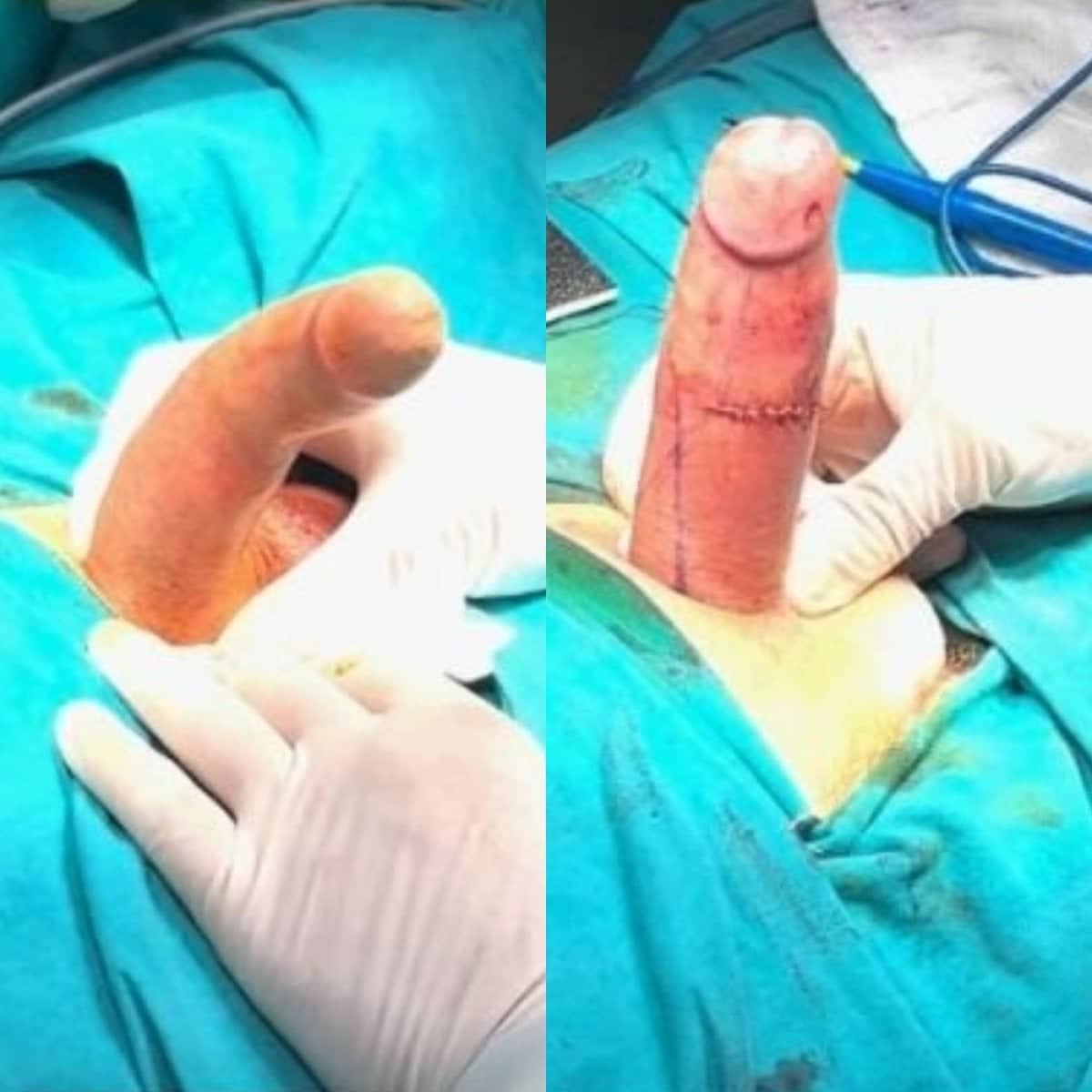 Case 14115 - penile implant surgery