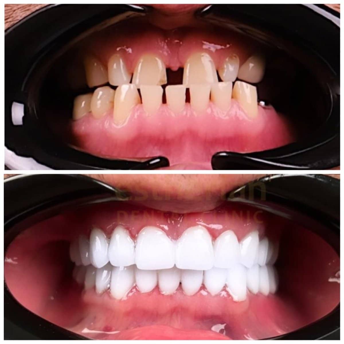 Case 14144 - root canal treatment