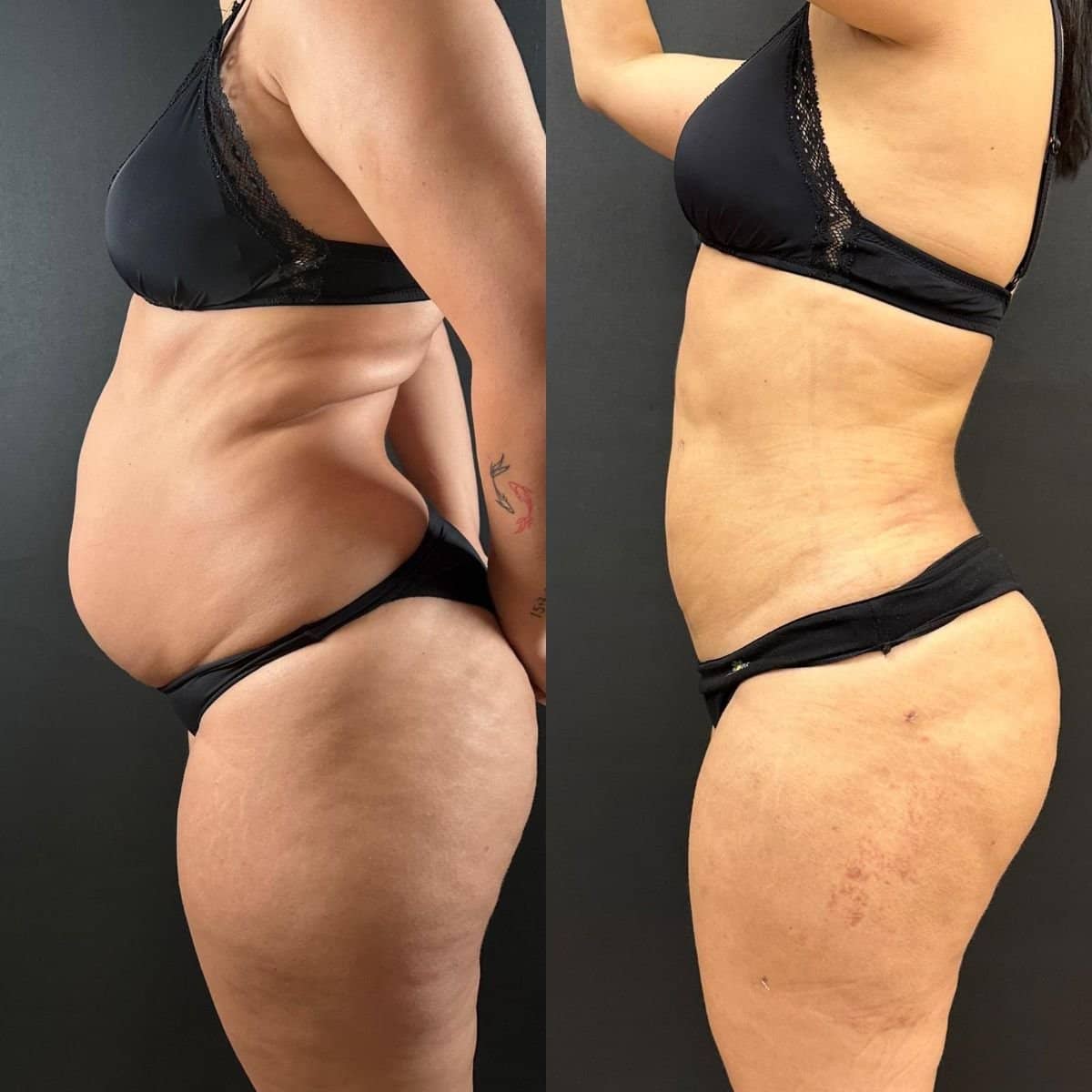 Case 14163 - tummy tuck