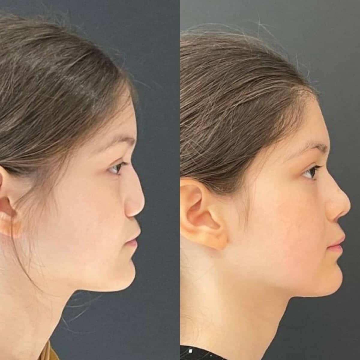 Case 14164 - rhinoplasty