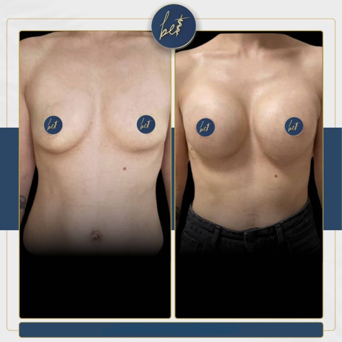 Case 14165 - mammoplasty