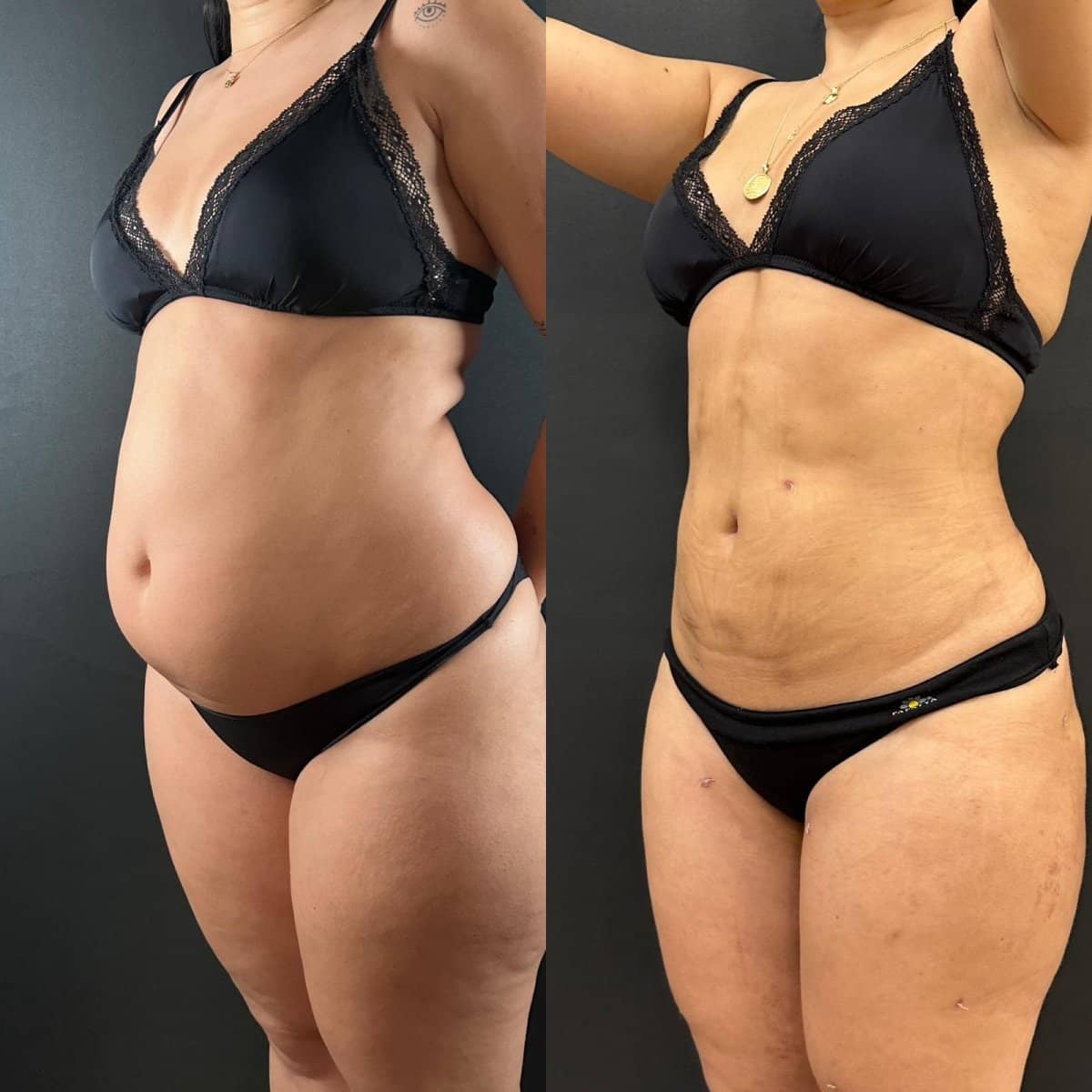 Case 14166 - Vaser liposuction
