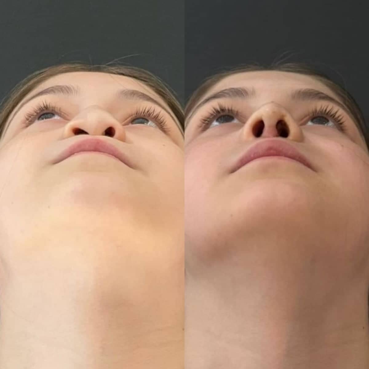 Case 14167 - rhinoplasty