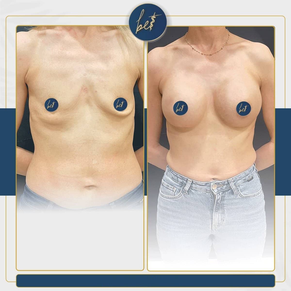 Case 14169 - mammoplasty