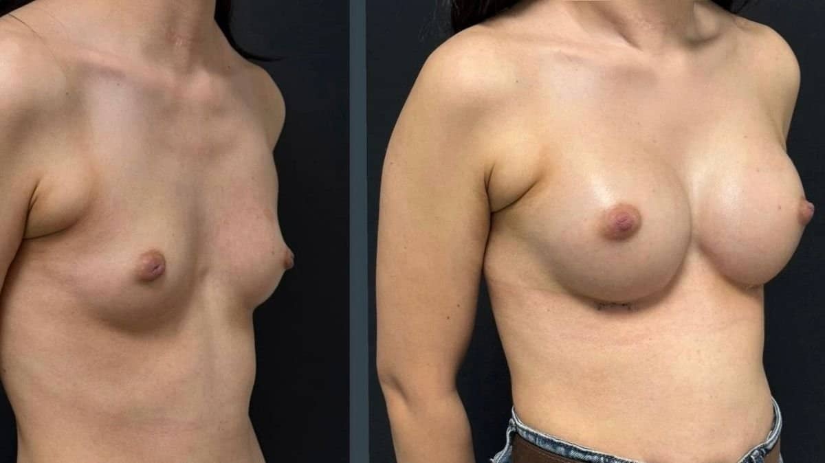 Case 14170 - breast augmentation