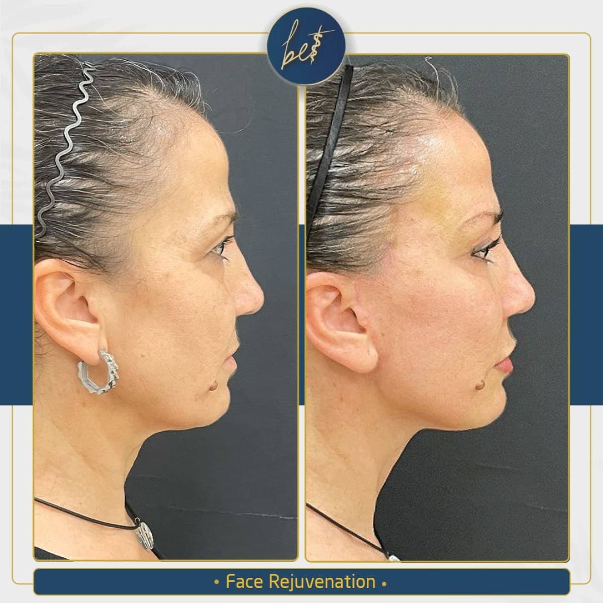Case 14172 - deep plane facelift