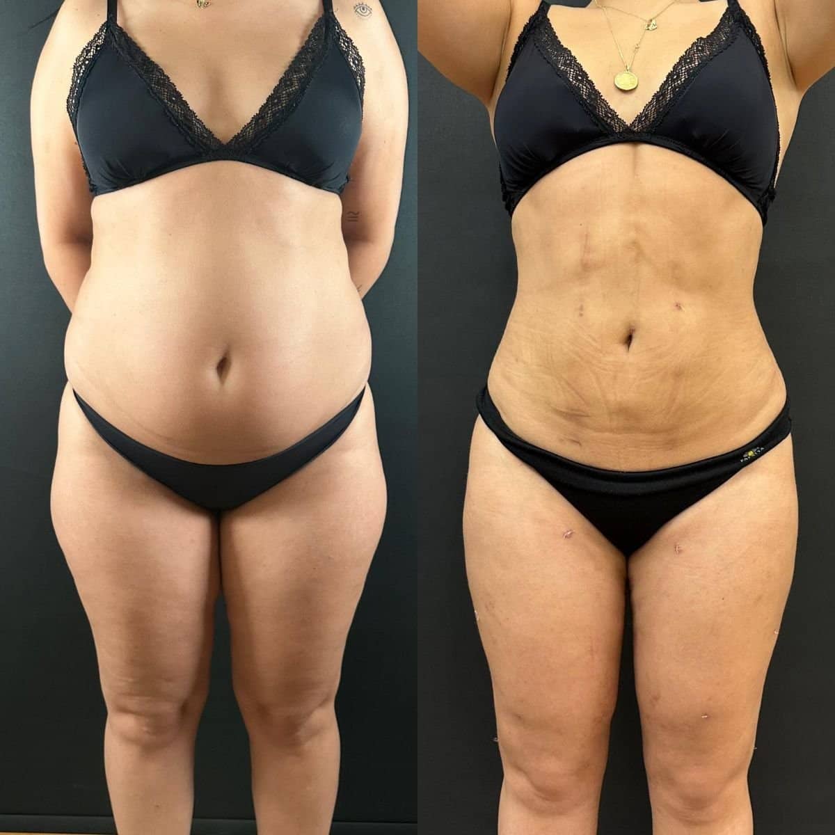 Case 14173 - tummy tuck