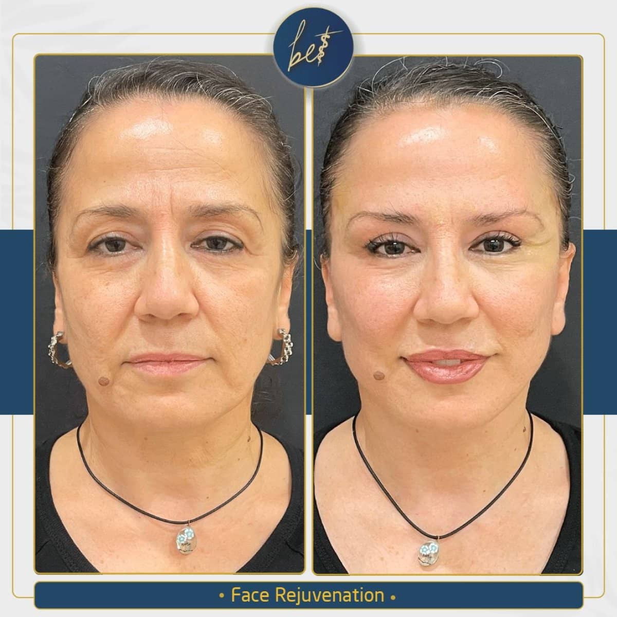 Case 14174 - deep plane facelift