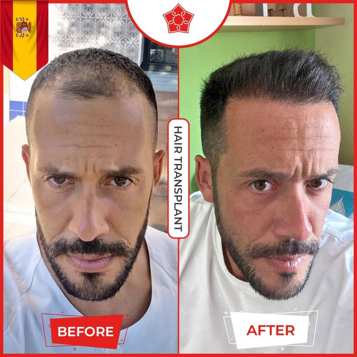 Case 14223 - FUE hair transplant