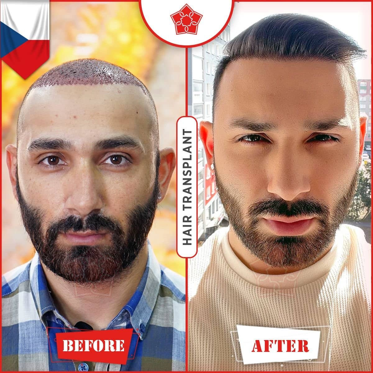 Case 14227 - FUE hair transplant