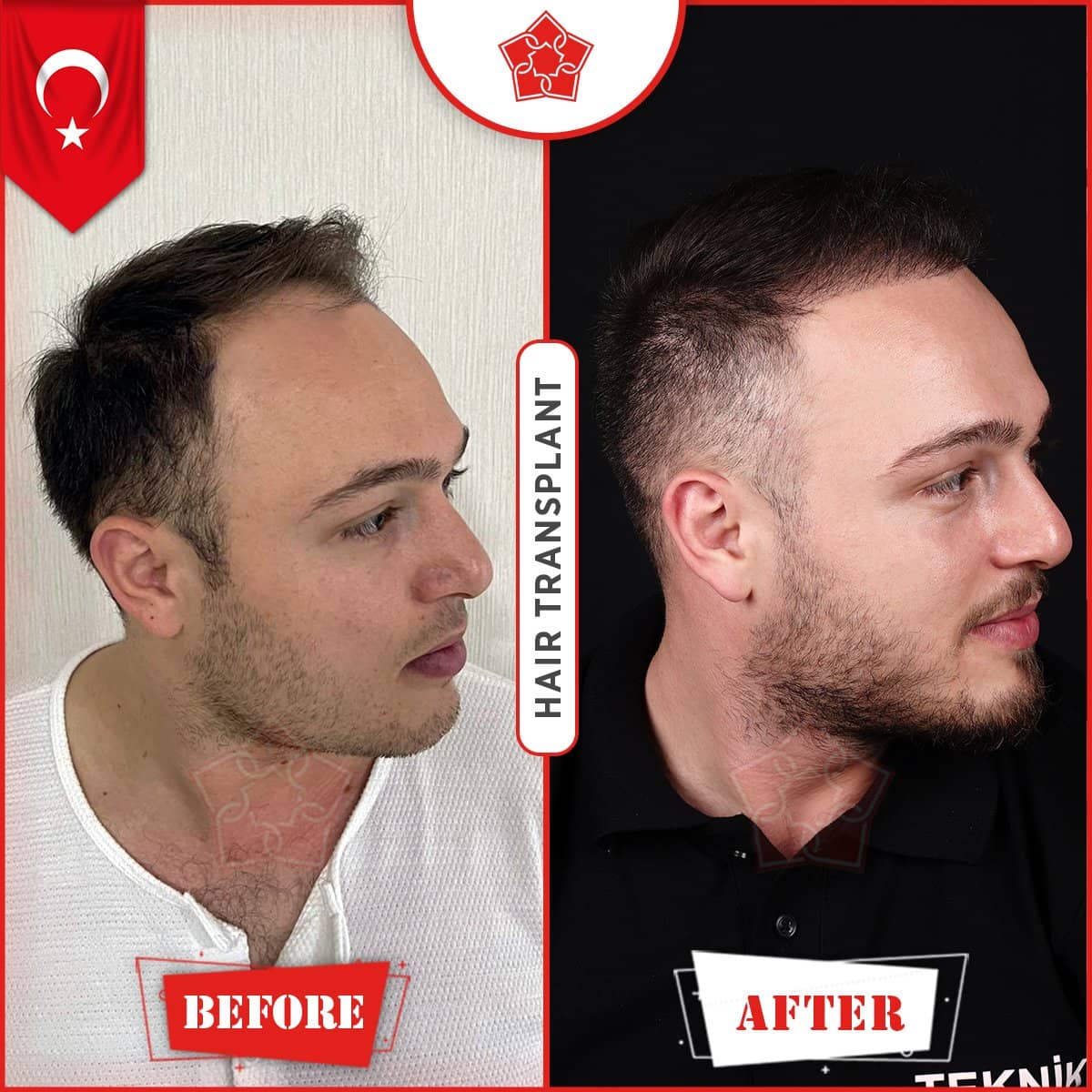 Case 14228 - hair transplant