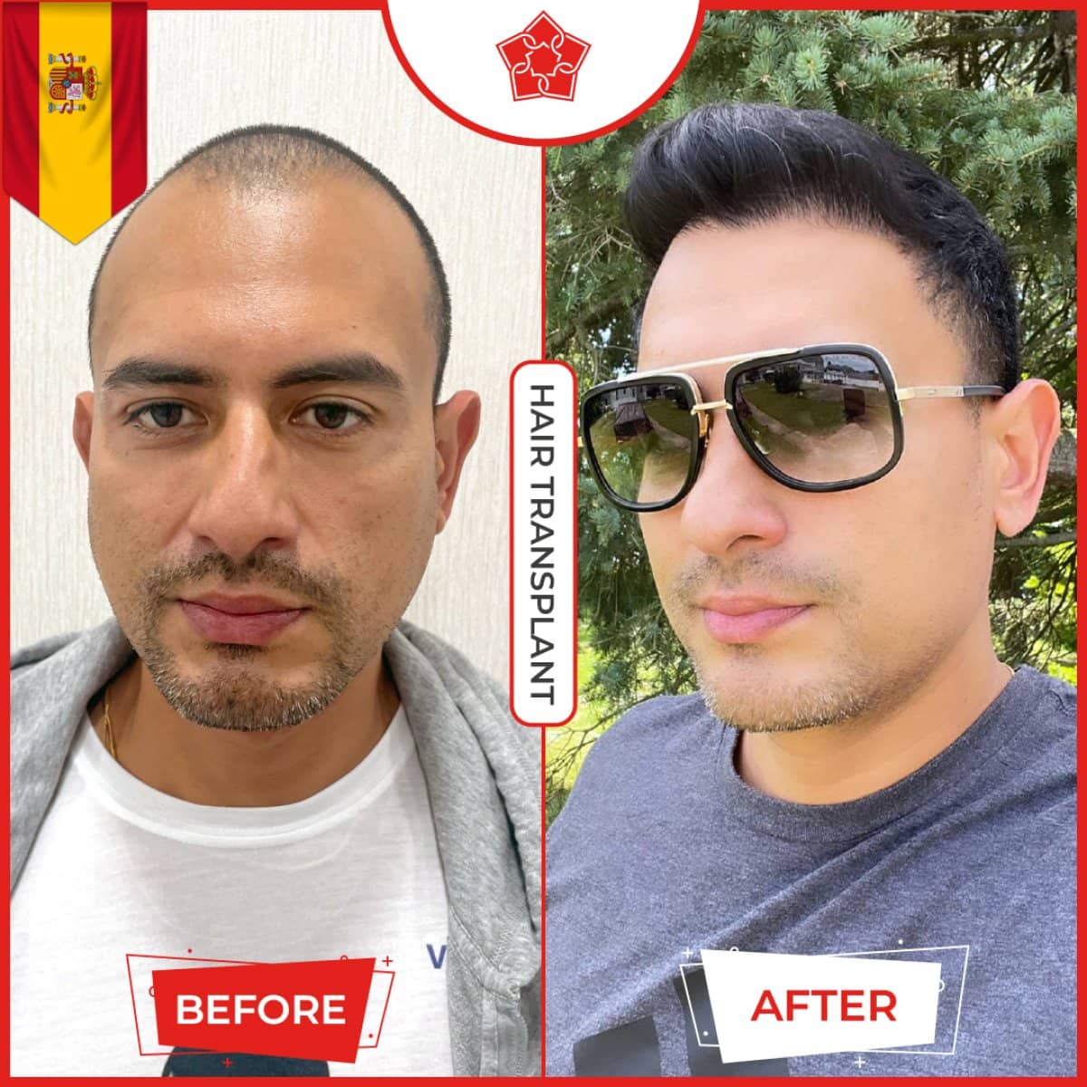 Case 14232 - hair transplant