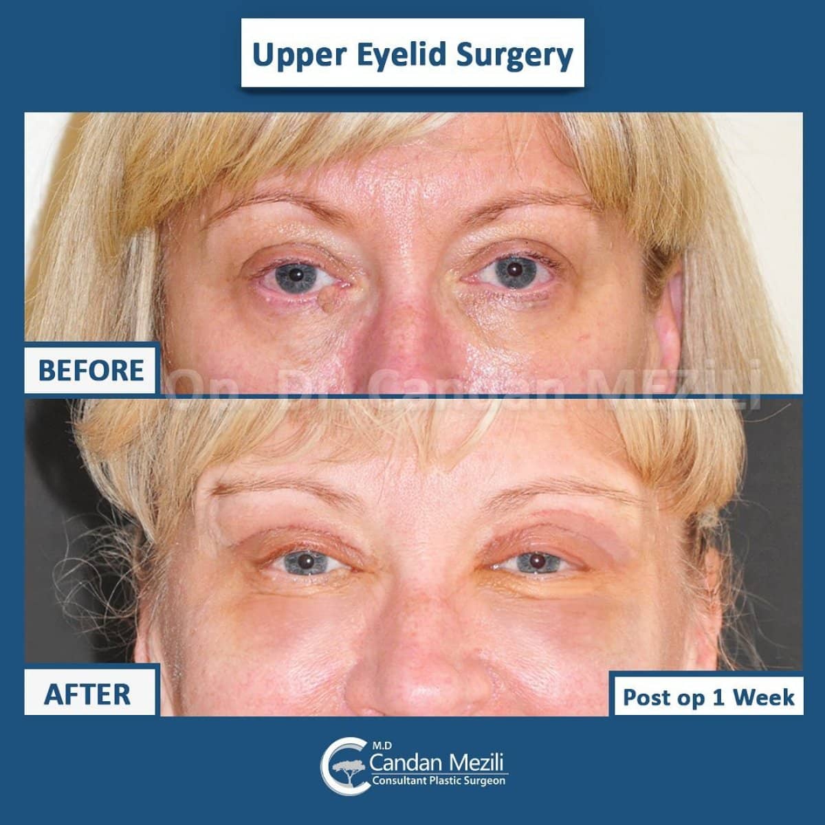 Case 14261 - upper eyelid blepharoplasty