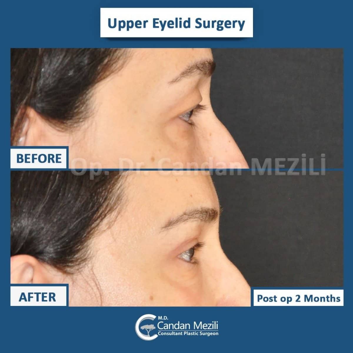 Case 14286 - upper eyelid surgery