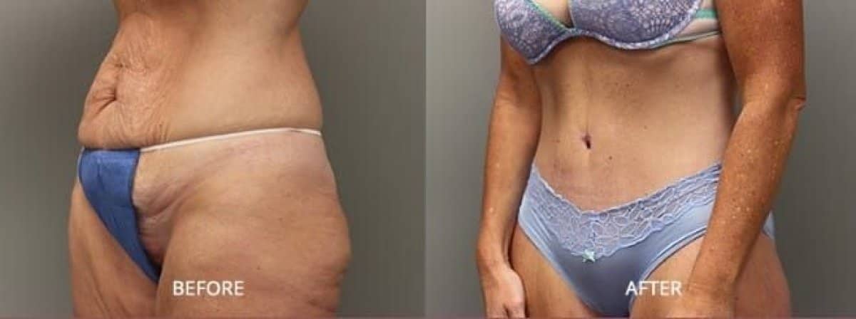 Case 14307 - tummy tuck