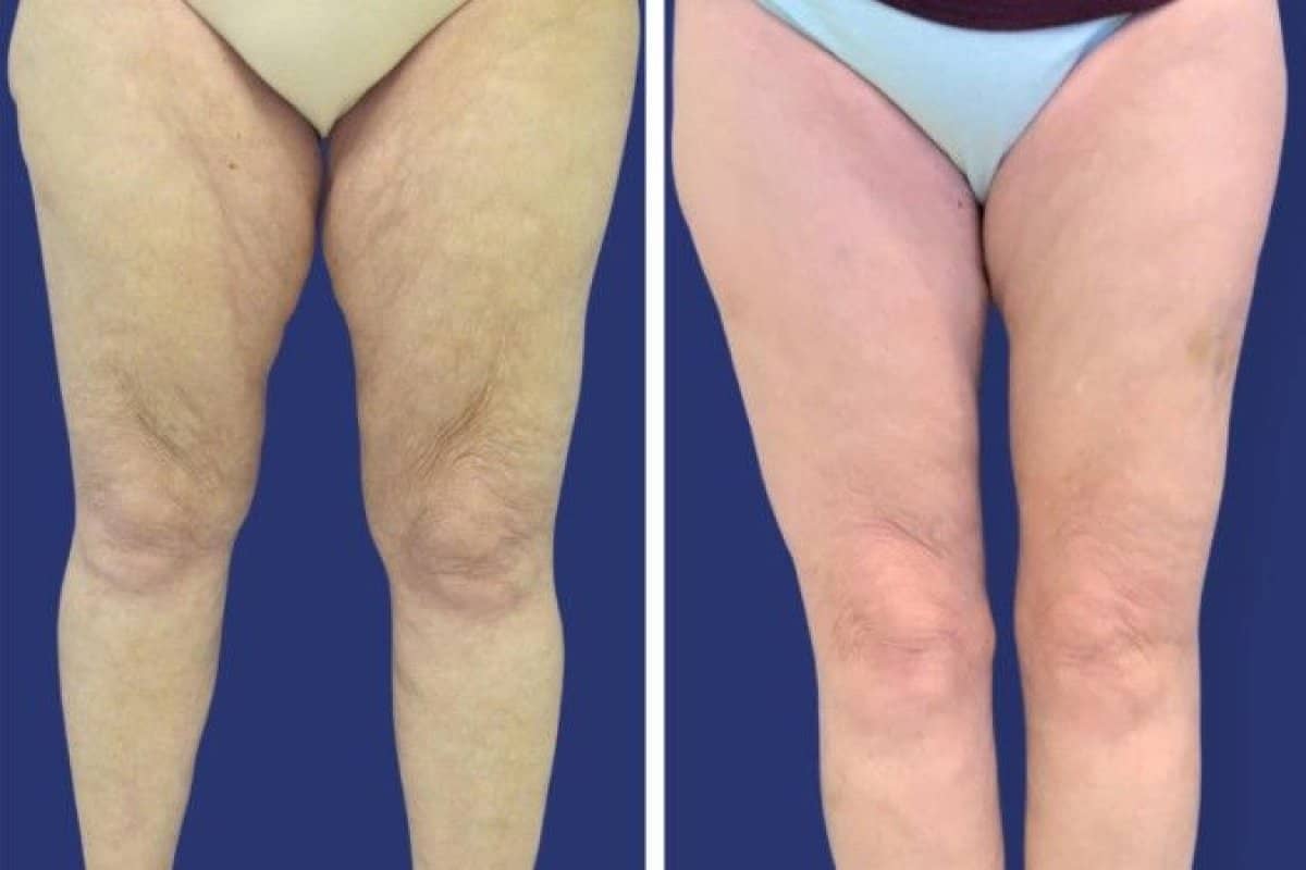 Case 14308 - thigh lift