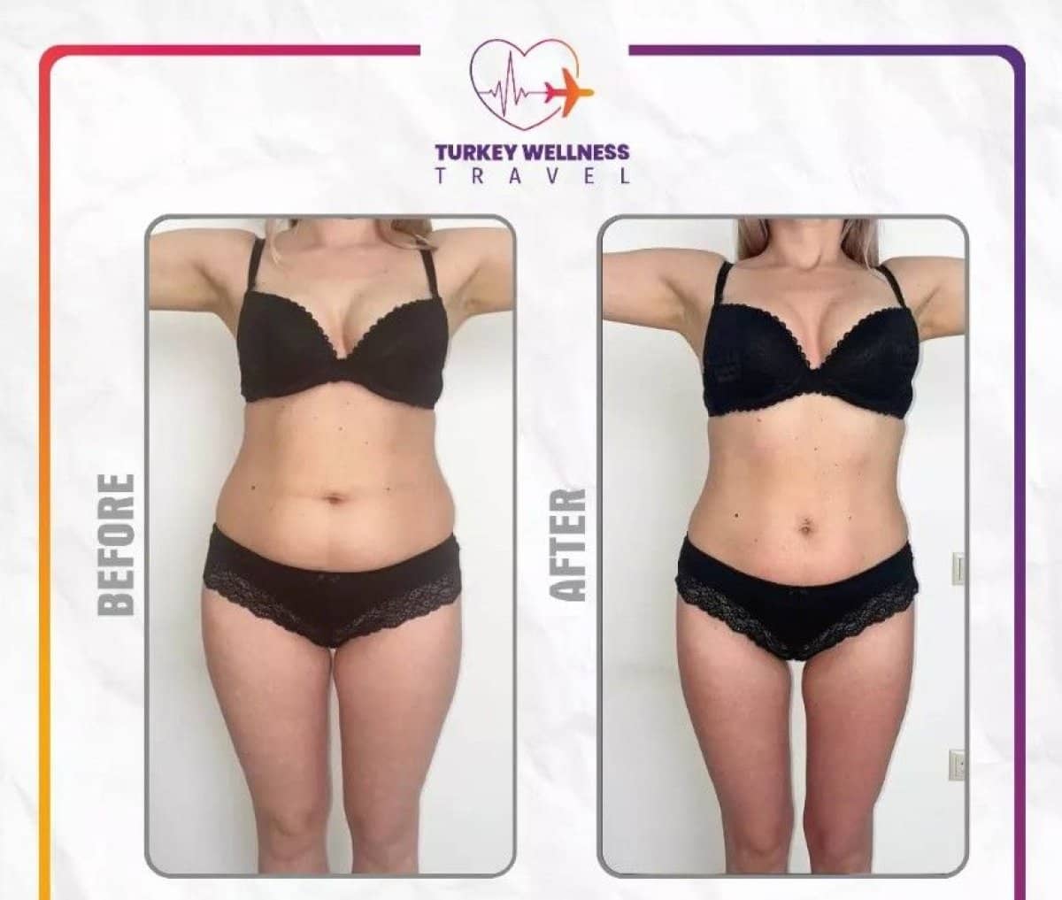 Case 14309 - liposuction