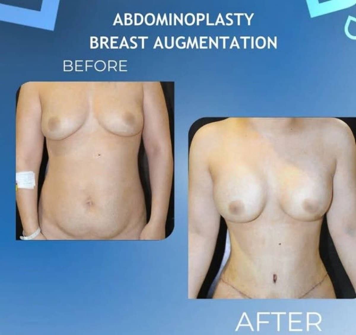 Case 14310 - abdominoplasty and breast augmentation