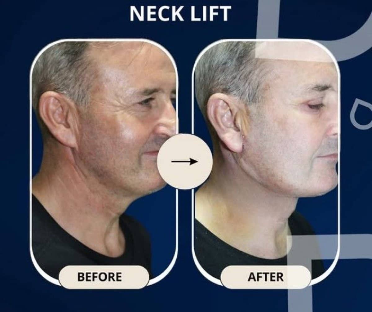 Case 14311 - neck lift