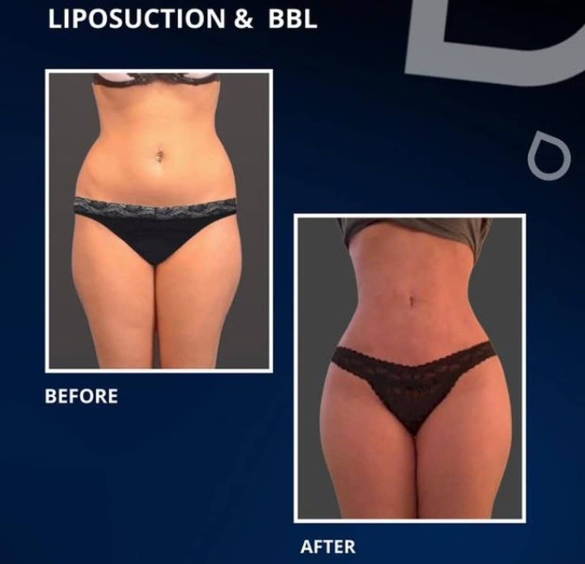 Case 14312 - liposuction and BBL