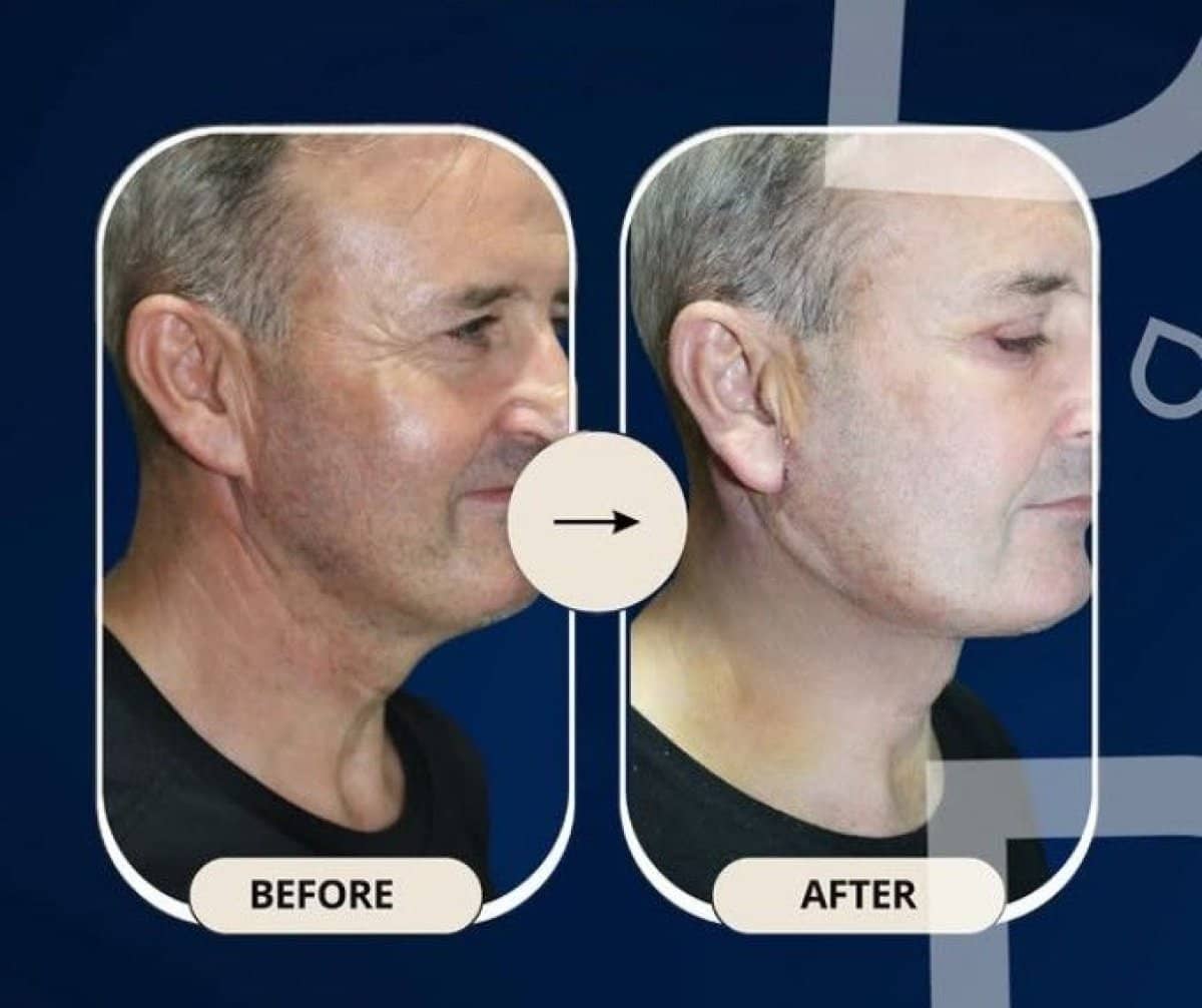 Case 14313 - neck lift