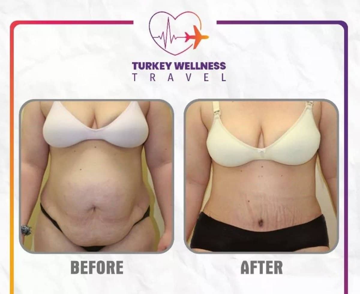 Case 14314 - liposuction