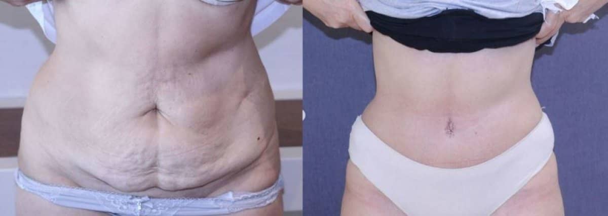Case 14316 - tummy tuck