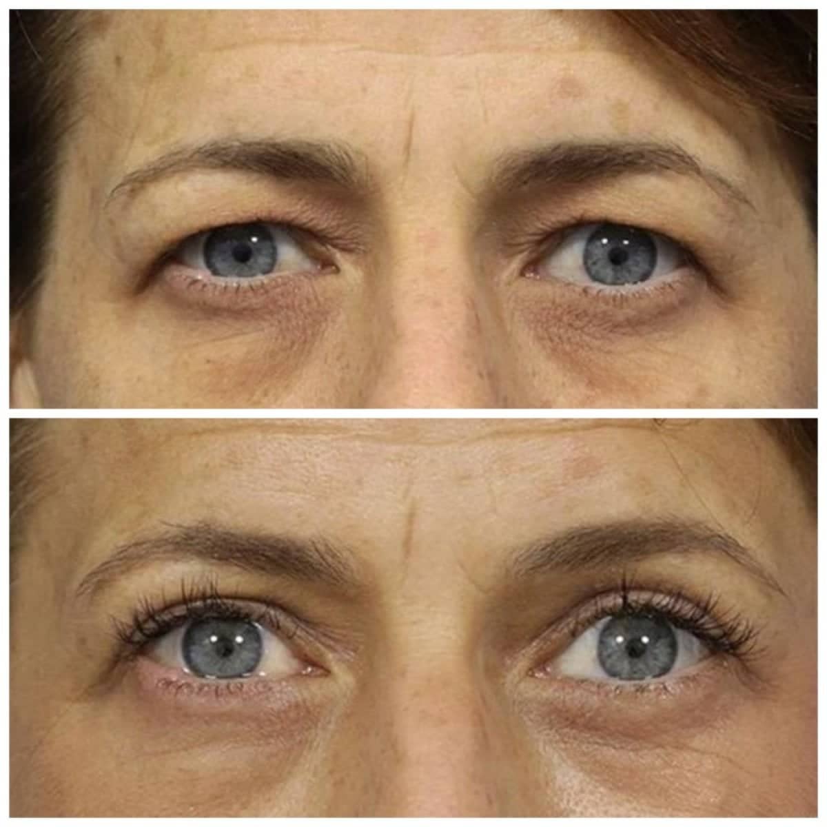 Case 14317 - blepharoplasty