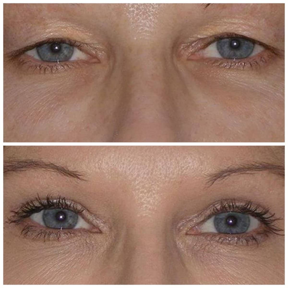 Case 14318 - blepharoplasty