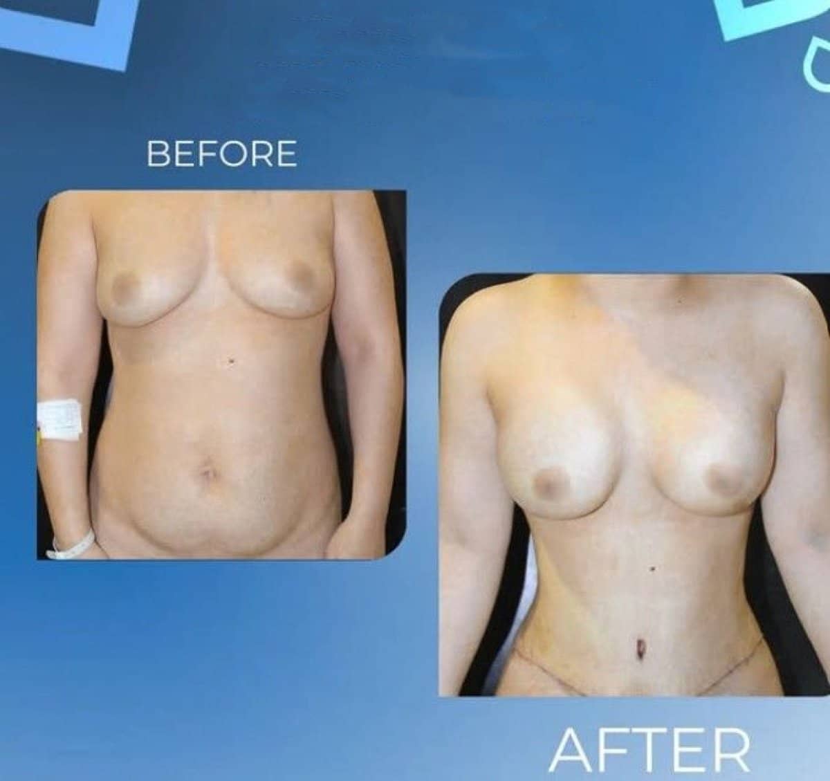 Case 14319 - breast lift