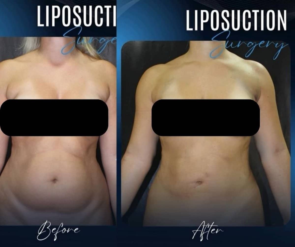 Case 14320 - liposuction