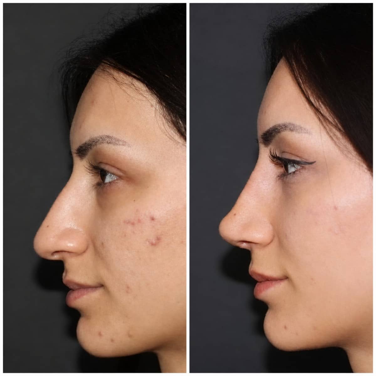 Case 14322 - rhinoplasty