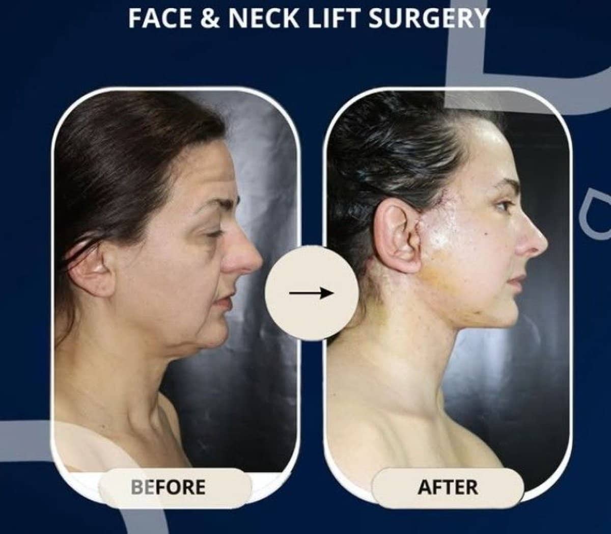 Case 14325 - facelift and neck lift