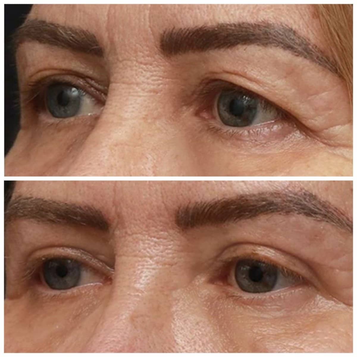 Case 14326 - blepharoplasty