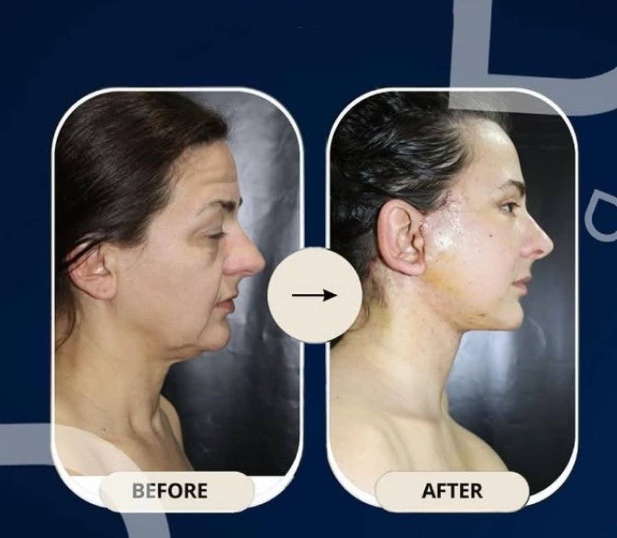Case 14329 - neck lift