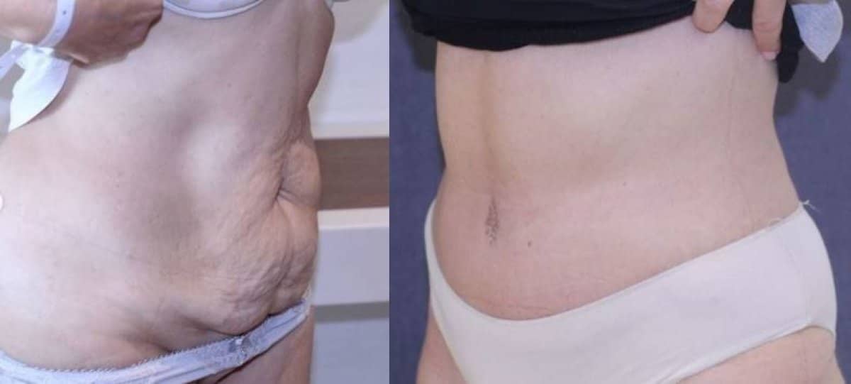 Case 14331 - tummy tuck