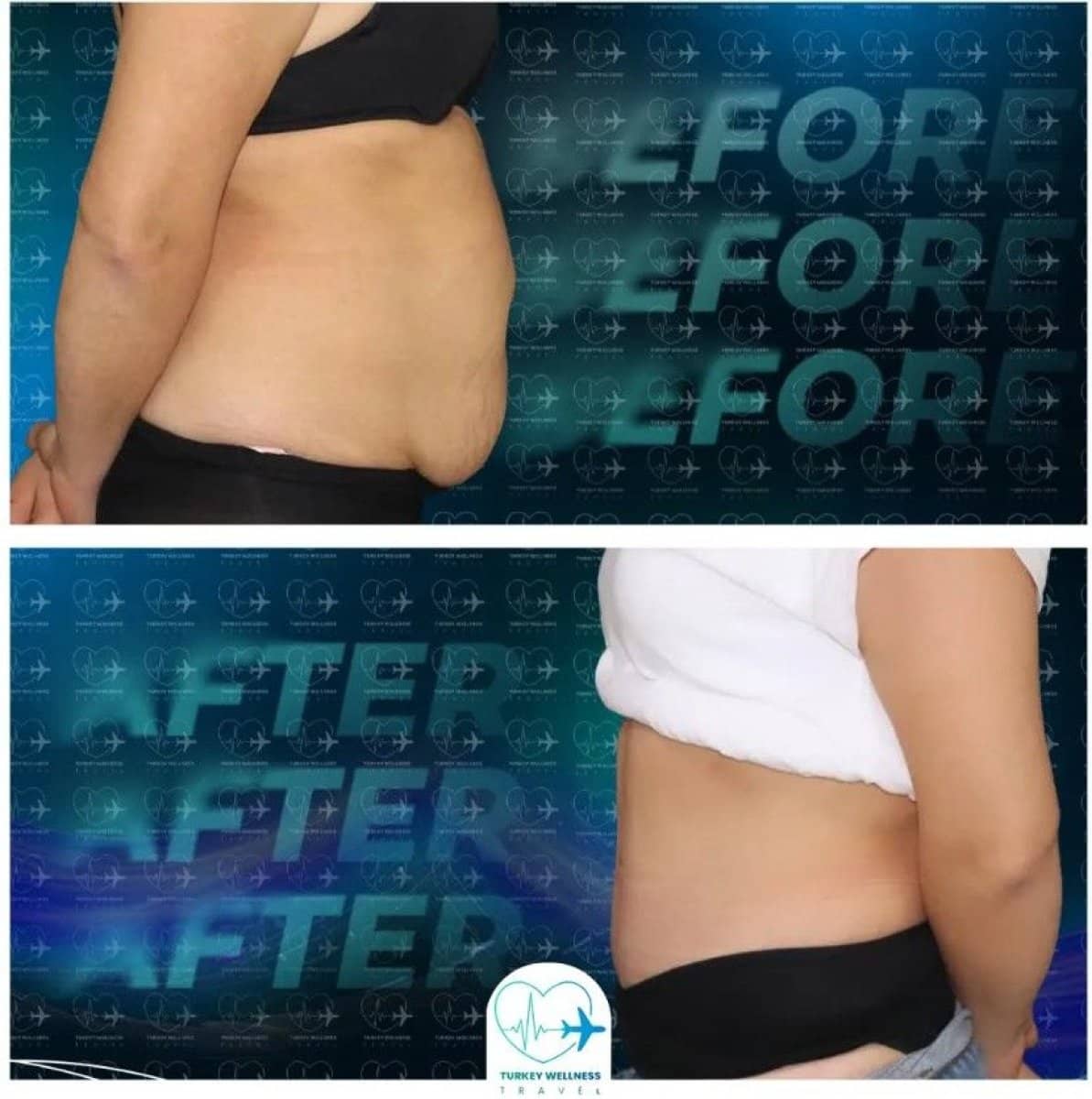 Case 14333 - liposuction