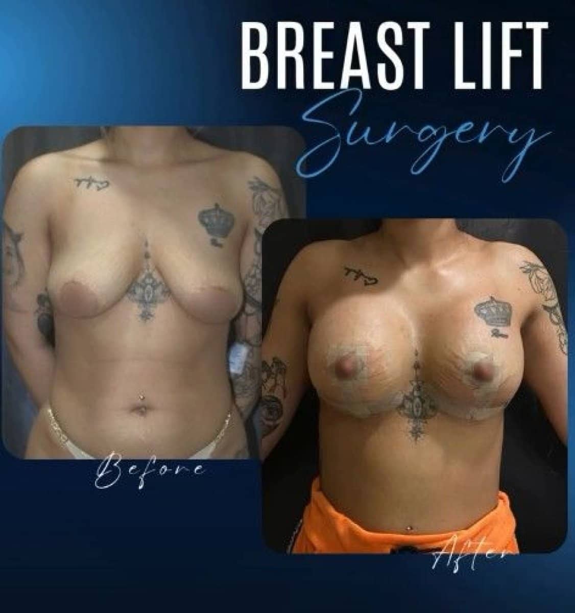 Case 14334 - breast lift surgery